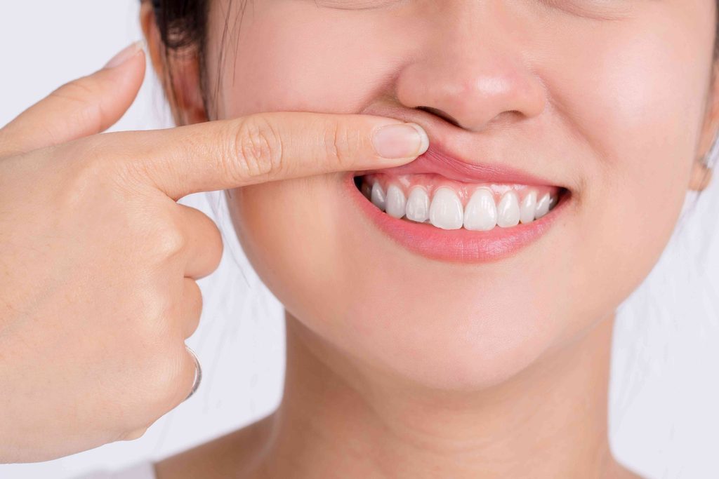 Woman showing off her gums