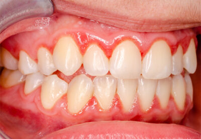 Up-close view of a person with gum disease.